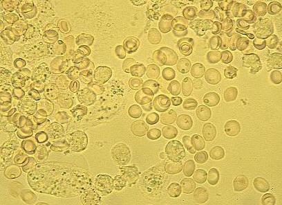 Лейкоциты микроскопия в моче повышены