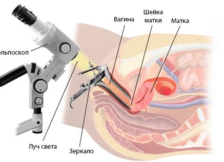 Кольпоскопическое исследование шейки матки