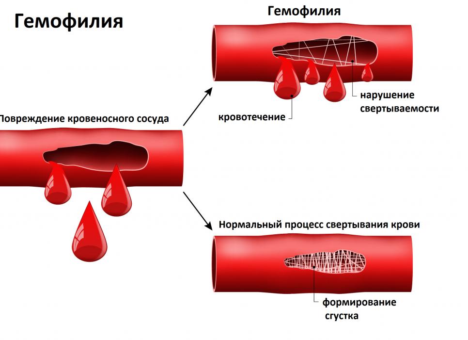 Как проверить свертываемость крови