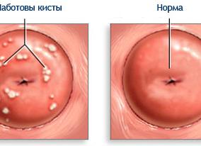Как лечится киста