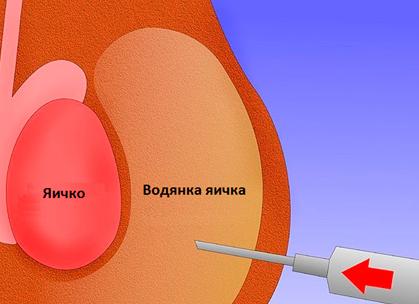 Как лечить водянку яичка у ребенка Как лечить водянку яичка у ребенка