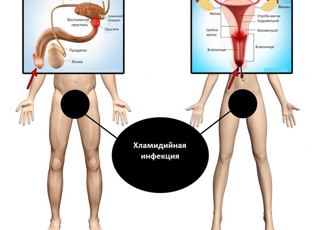 Хламидия это бактерия или вирус