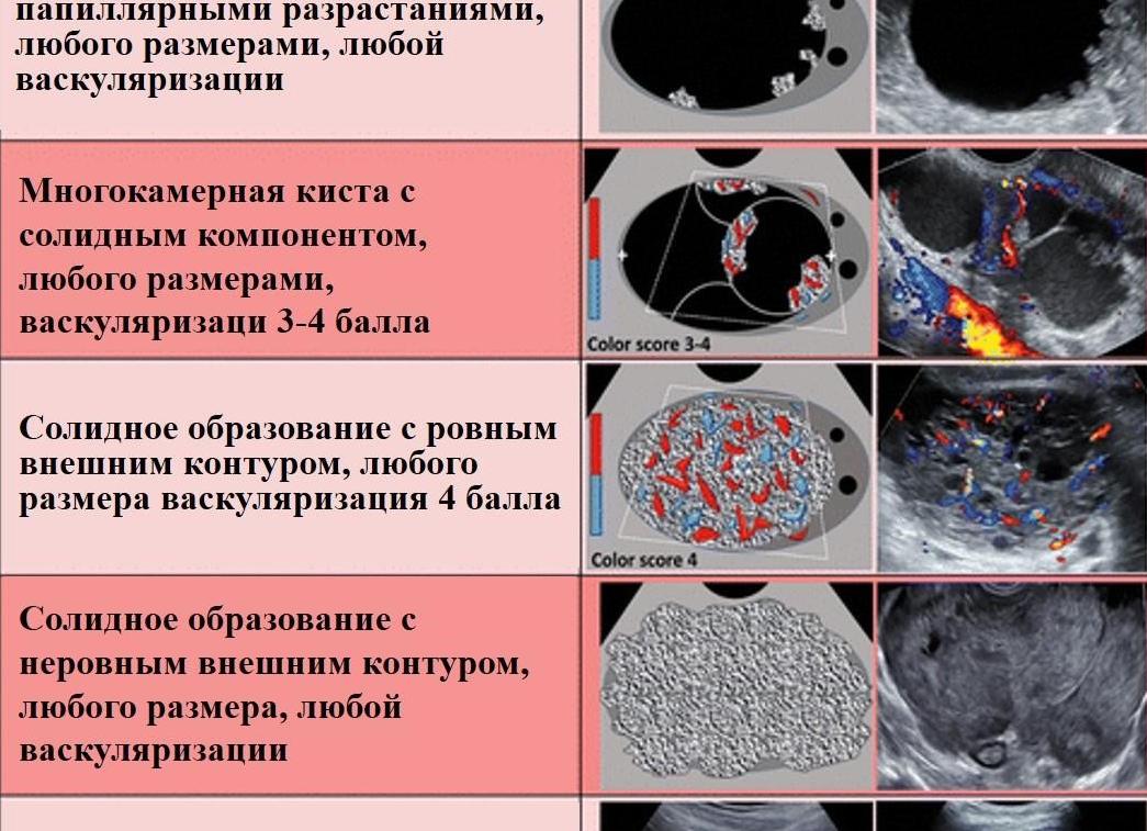 Гетерогенное образование в яичнике