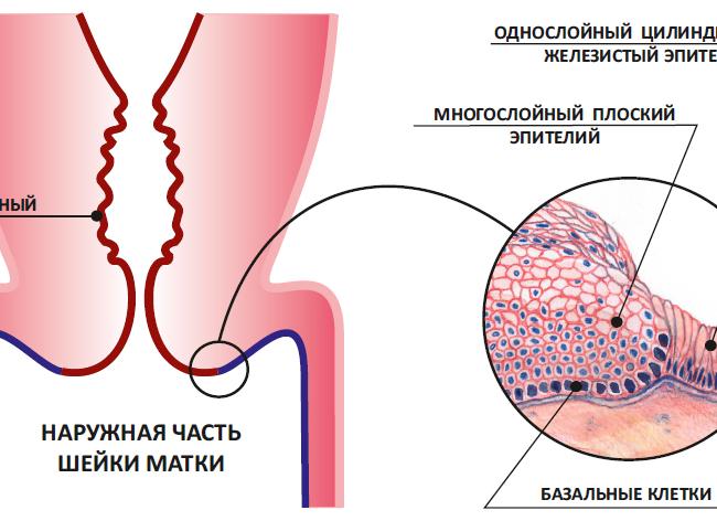 Экзоцервикс что это такое в гинекологии