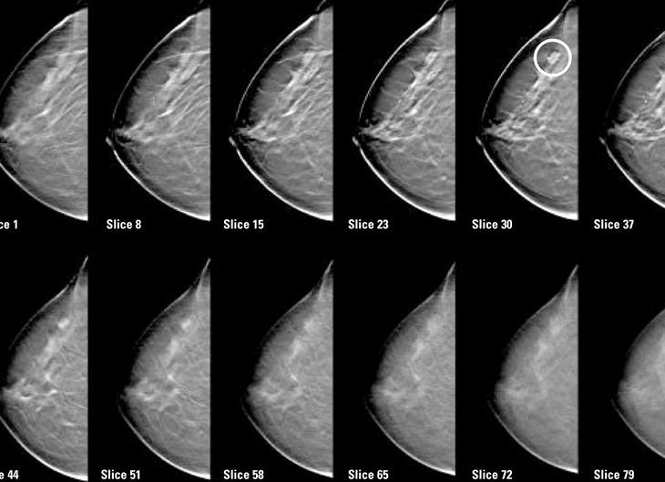 Что выявляет маммография
