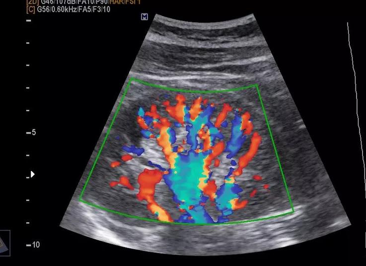 Что такое цдк при узи