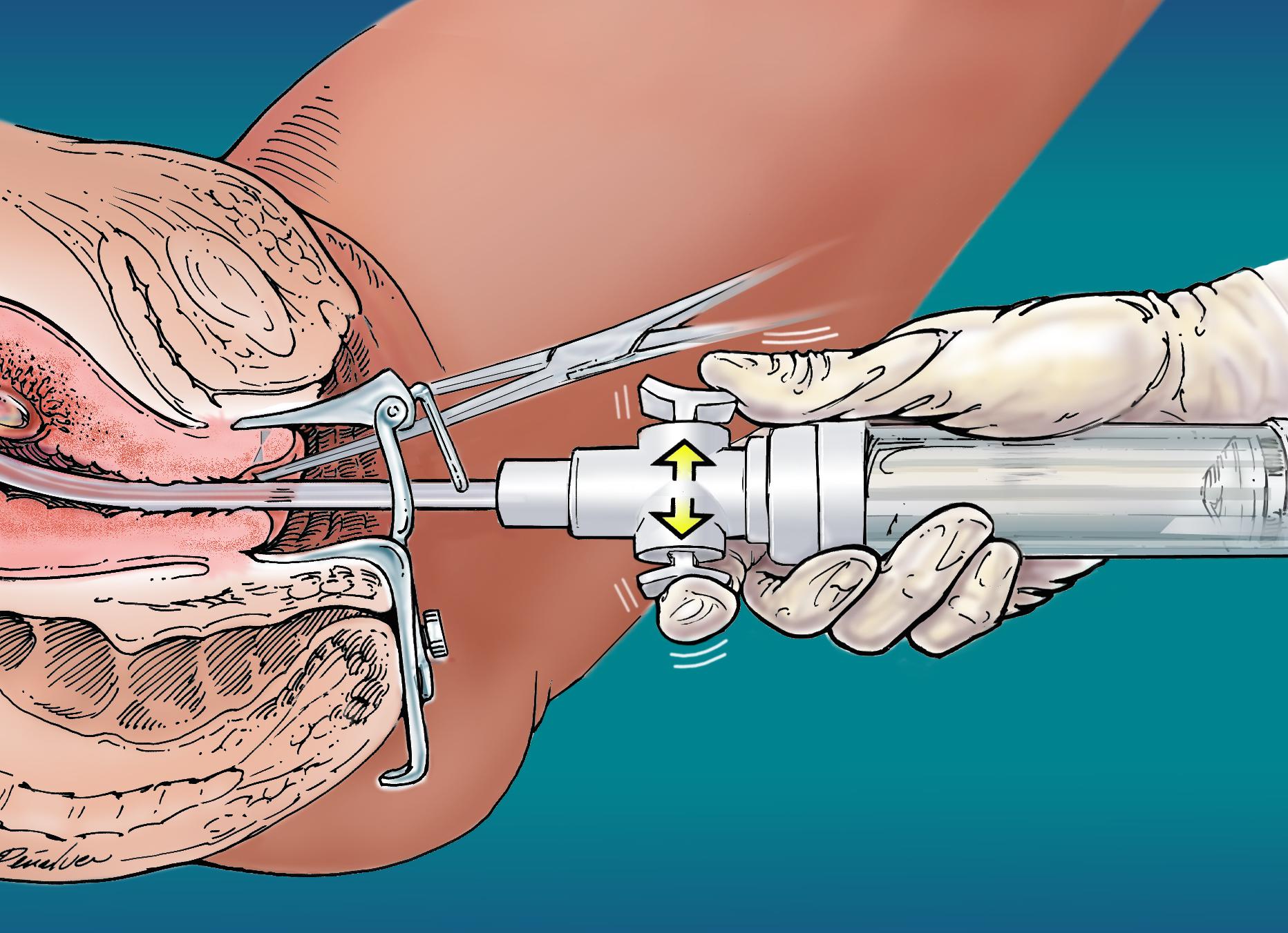 Что такое анализ на биопсию