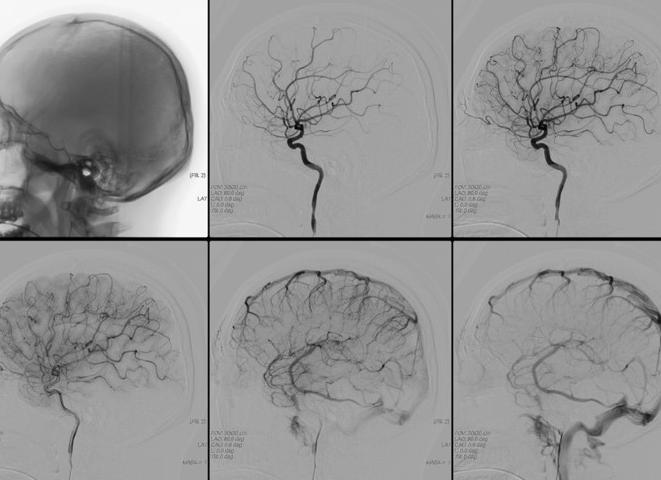 Ангиография артерий головного мозга