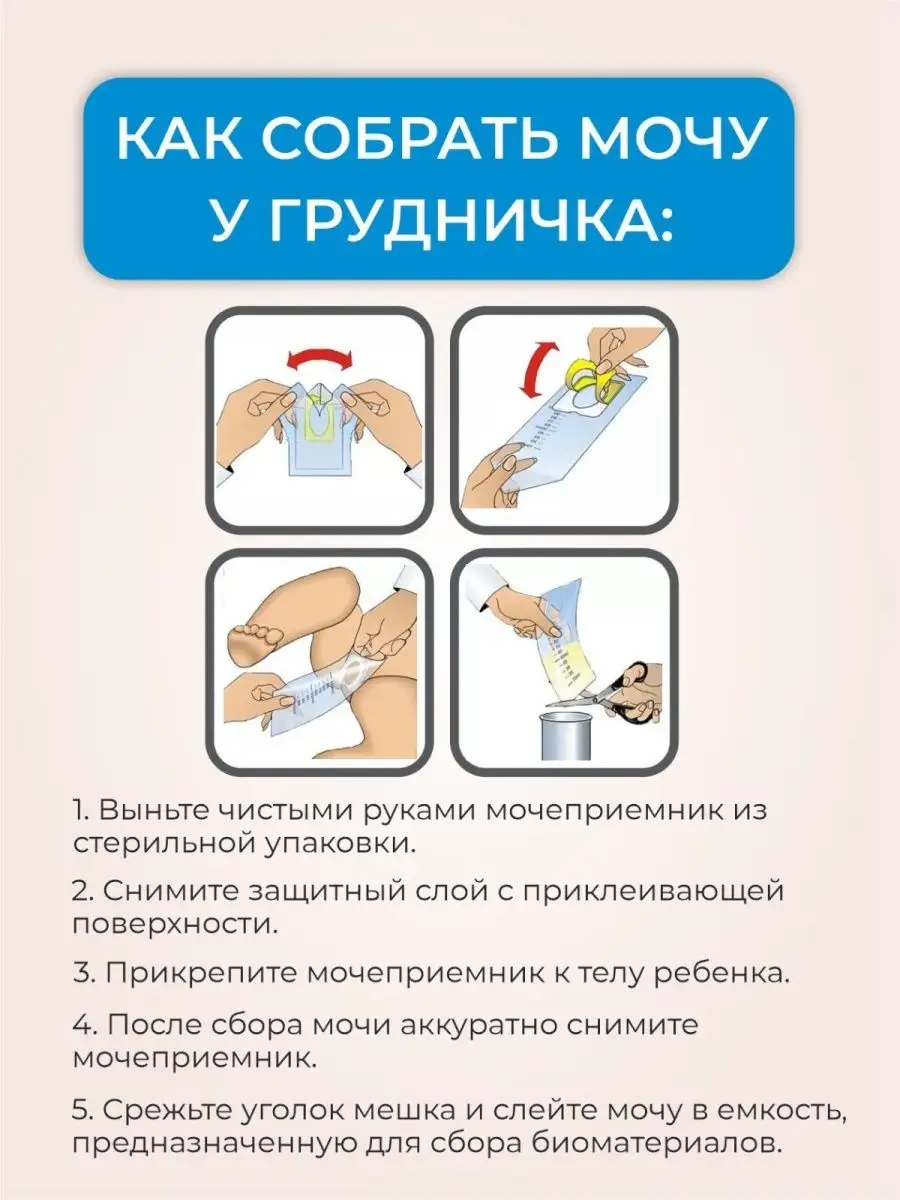 Как собрать мочу у грудничка мальчика мочеприемником