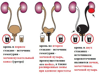 Кровь в моче без боли у женщины что это может быть