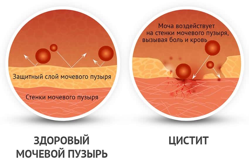 Кровяные выделения при цистите