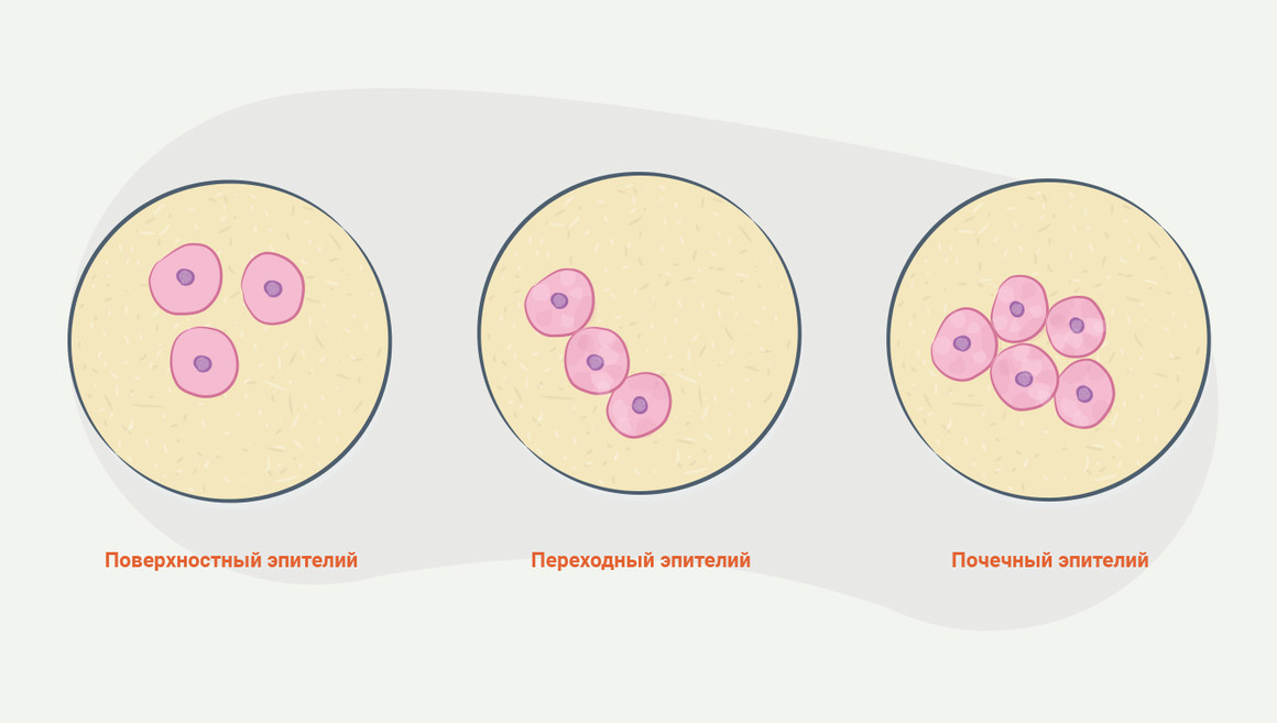 Много эпителия в моче