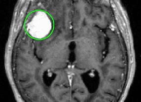 Мрт при мигрени