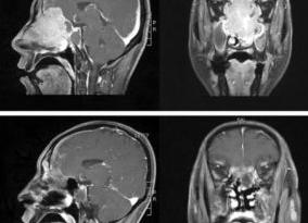 Мрт гайморовых пазух Мрт гайморовых пазух