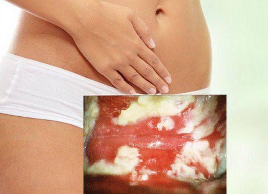 Можно ли при молочнице заниматься спортом