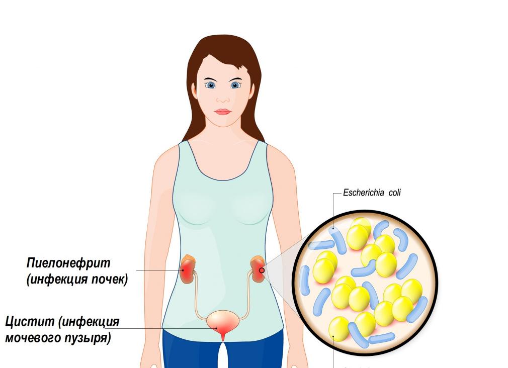 Моча мутная с хлопьями