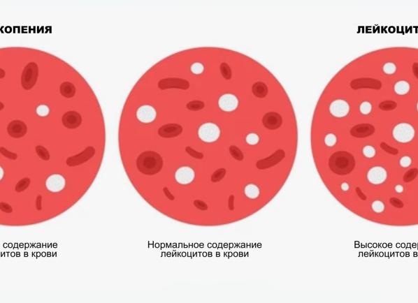 Лейкопения у детей Лейкопения у детей