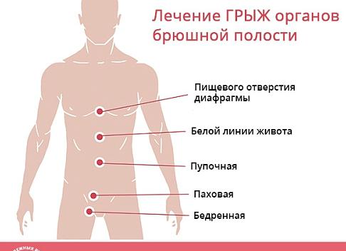 Грыжа узи брюшной полости