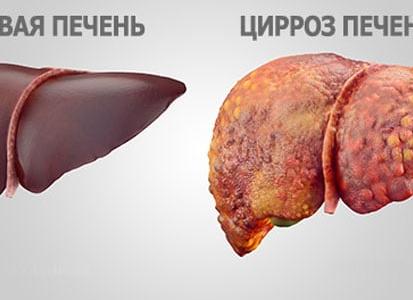 Если в крови повышен фибриноген