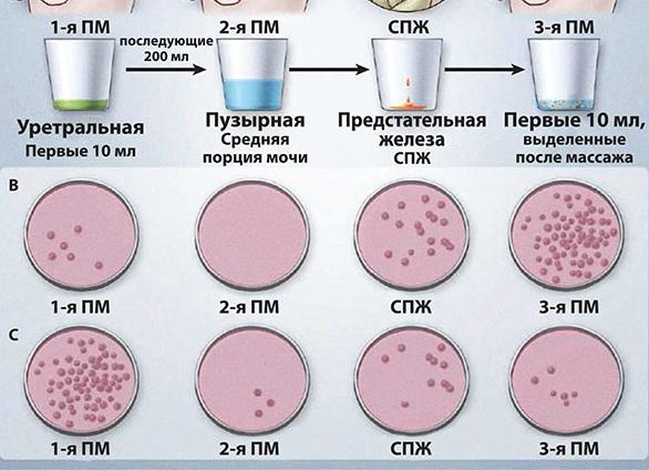 Двухстаканная проба мочи