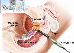 Что такое трузи предстательной железы