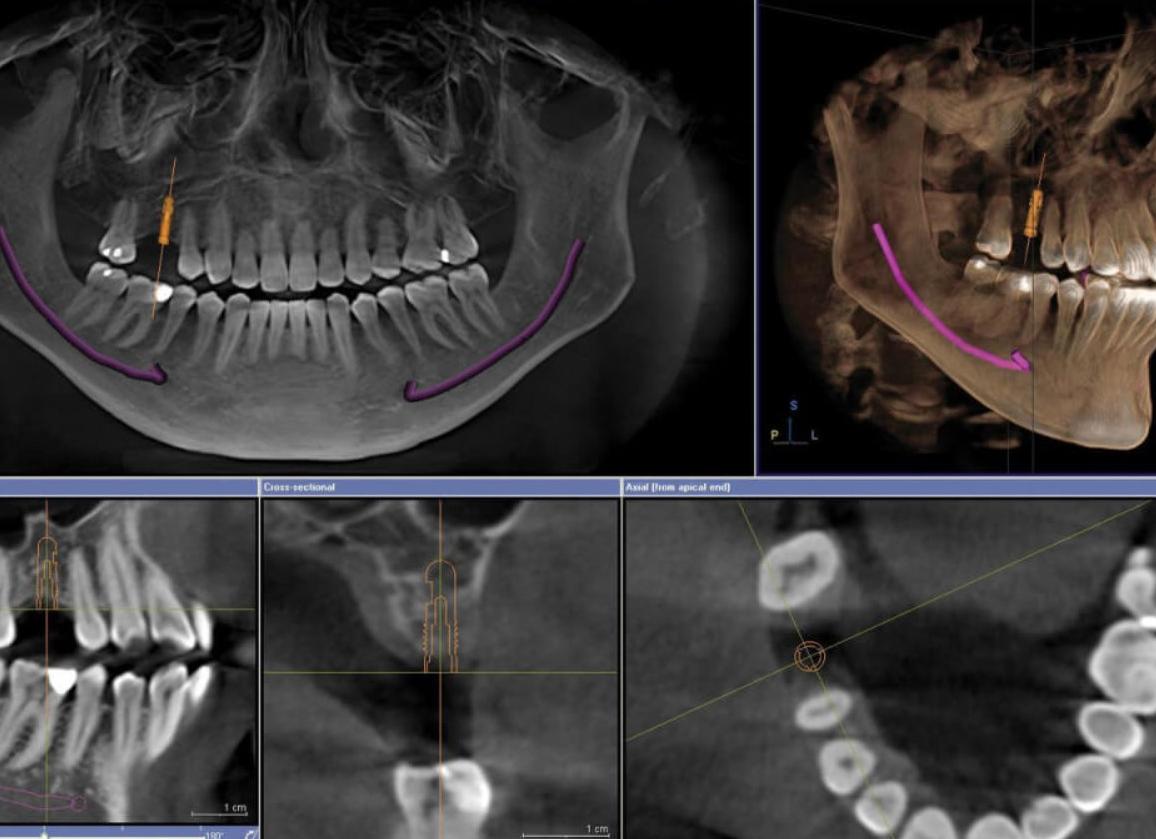 Что показывает кт челюсти
