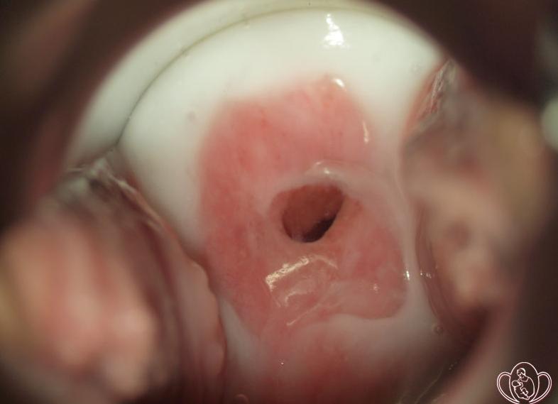 Белые выделения у женщин кремообразные Белые выделения у женщин кремообразные