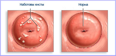 Киста это что