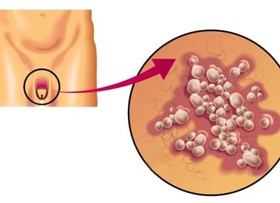 Мужские венерические заболевания