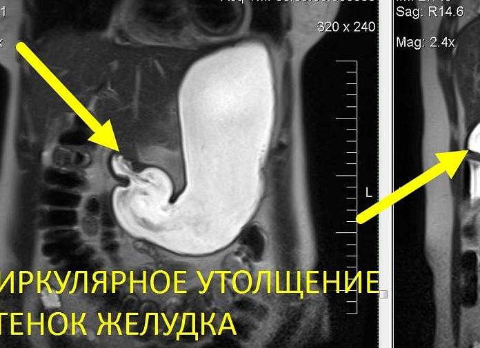 Мрт желудка и пищевода