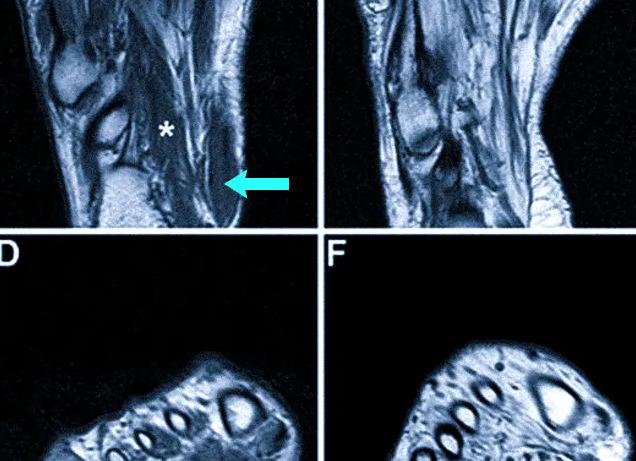 Мрт ноги что показывает