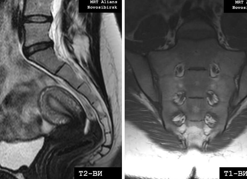 Мрт крестцово копчикового отдела позвоночника