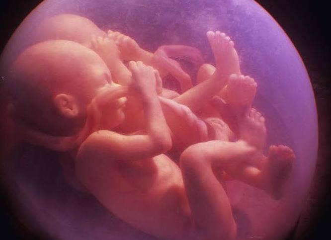 Монохориальная двойня что это