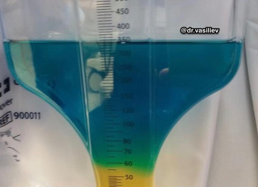 Моча синего цвета