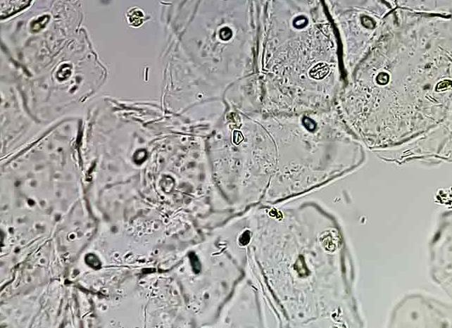 Много эпителия в моче