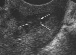 Гиперэхогенные включения в матке что это такое