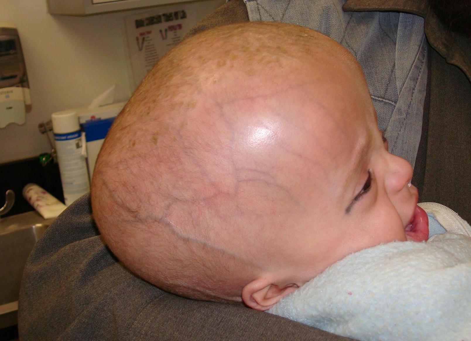 Гидроцефалия что это такое