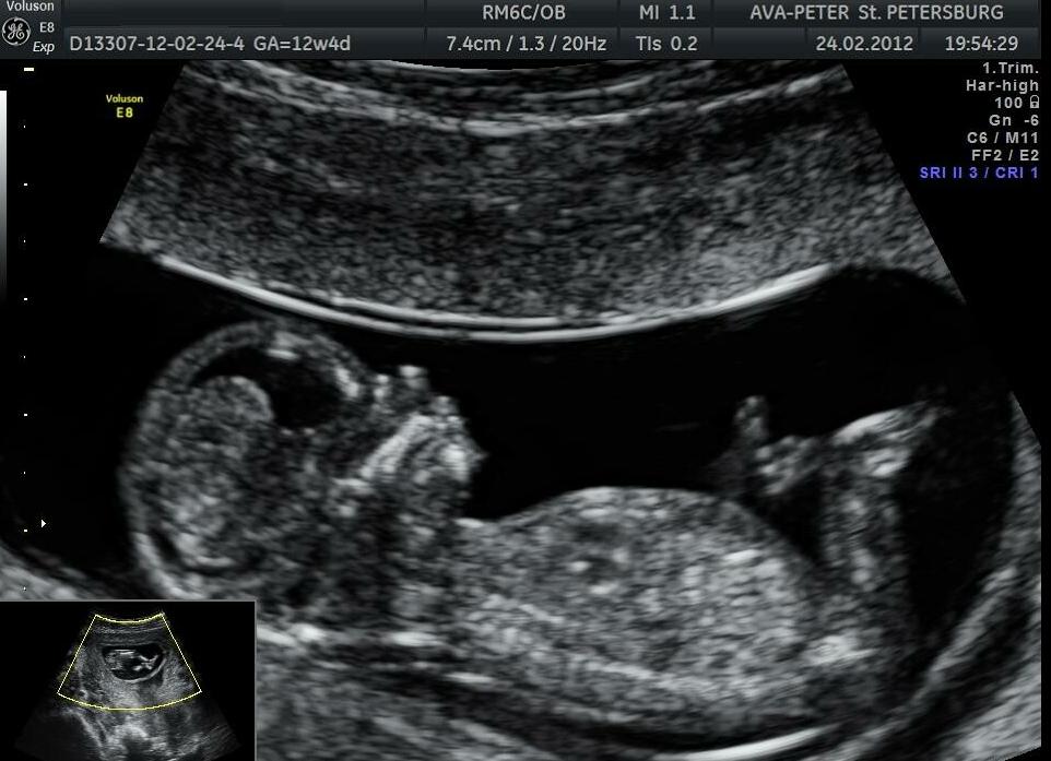 Фото узи плода