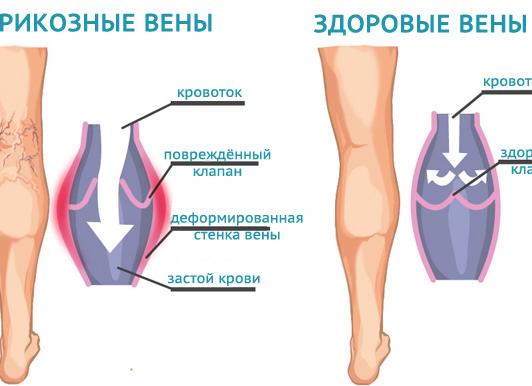 Цдк вен нижних конечностей что это такое