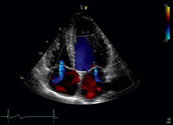 Болезни сердца узи