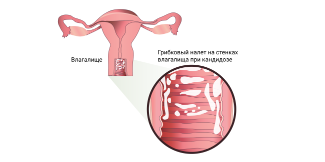Кислый запах выделений