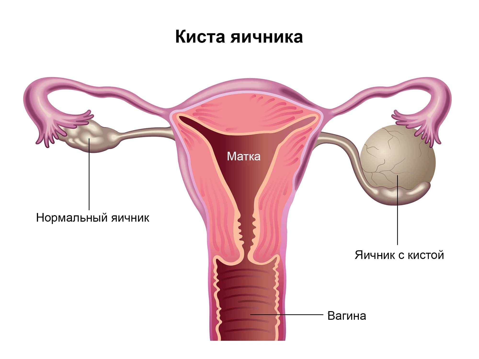 Киста яичника причины