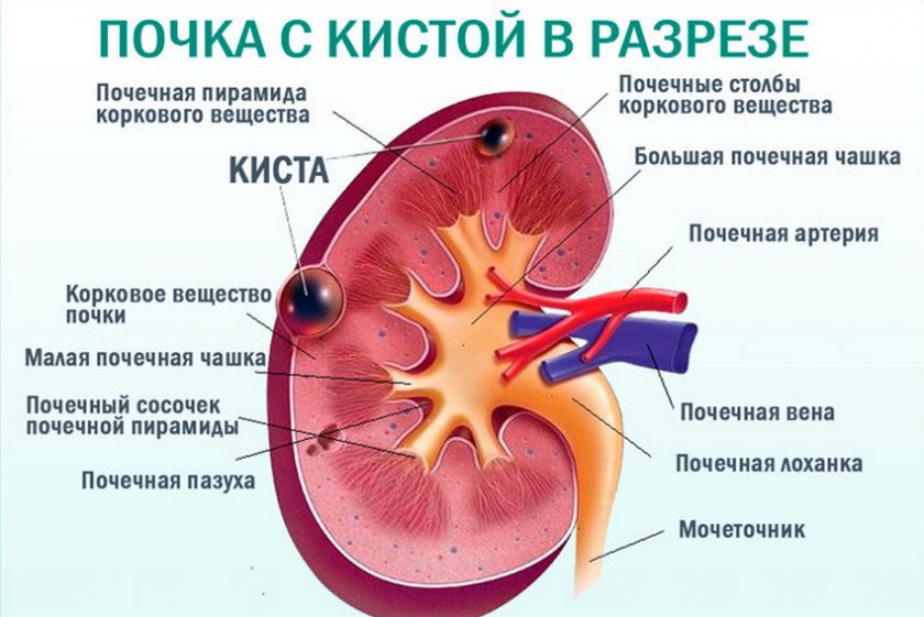 Киста почки паренхимы
