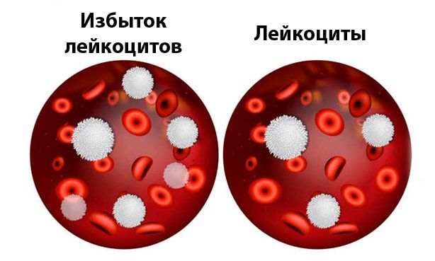 Лейкоцитоз в крови у ребенка причины