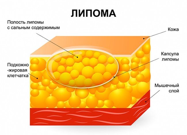 Липома грудной железы
