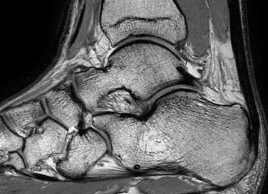 Мрт голеностопного сустава что показывает