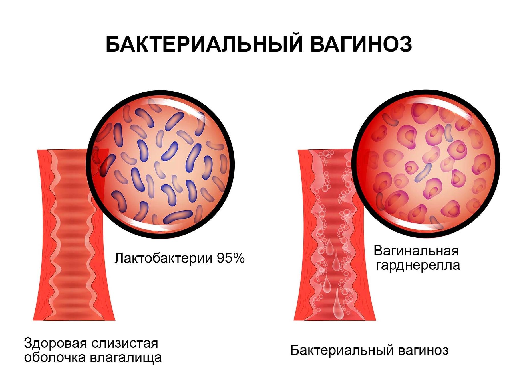 Кокки чем лечить