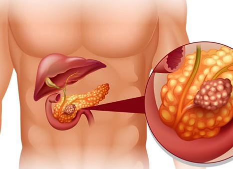 Киста в желудке
