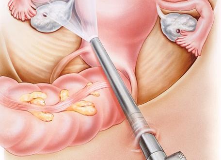 Как чистят трубы у женщин