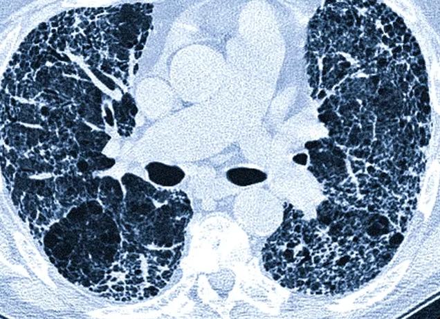 Как часто можно делать кт легких